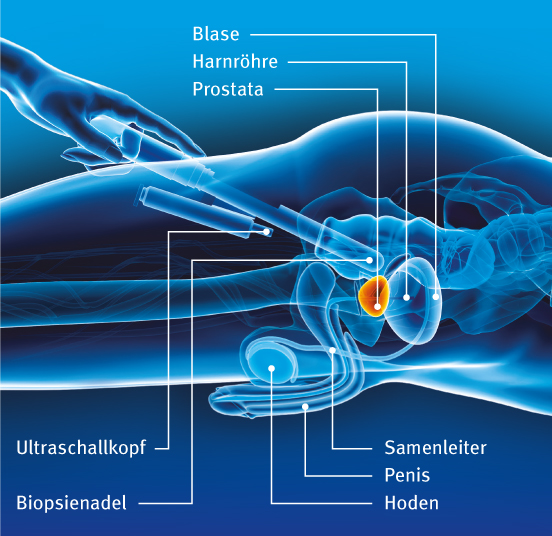 Illustration: Gewebeentnahme unter Ultraschallkontrolle