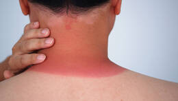 Sonnenbrand im Nacken mit geröteter Haut