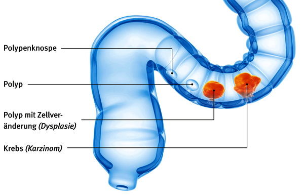 Illustration: Polypen im Darm können bei einer Darmspiegelung entfernt werden